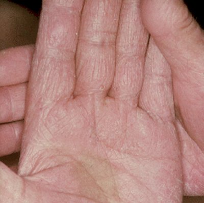 Tinea Corporis - Symptoms, Diagnosis, Treatment of Tinea ...