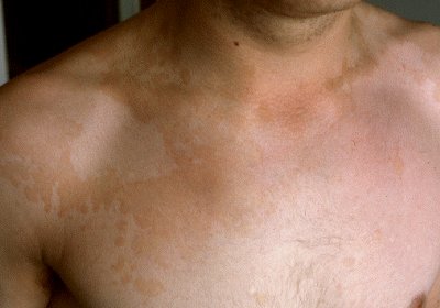 Tinea Versicolor – Pictures, Symptoms, Causes, Natural ...